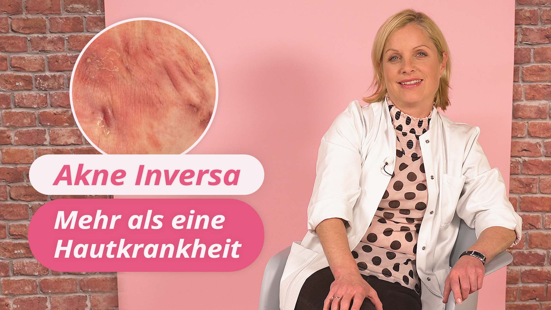 Vorschaubild zum Kurs: Akne inversa: Mehr als eine Hautkrankheit